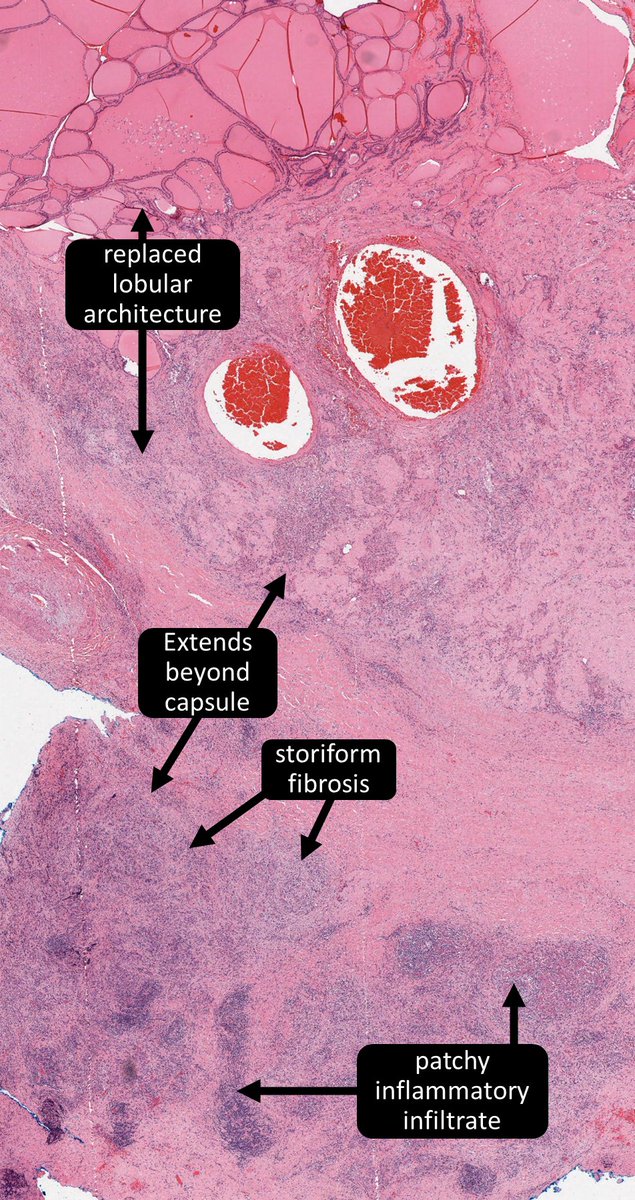 DrCycloPath's tweet photo. ✅Riedel Thyroiditis
potentially an IgG4-related disease (storiform fibrosis, obliterative phlebitis)
patchy infiltrate, extension beyond capsule
replacement of lobular architecture
🔬https://t.co/9OaWRL1PLl
🔬https://t.co/uAy0iAC5aV
#Thyroid #EndoPath #ENTPath #PathTwitter #Pathology #Pathologists