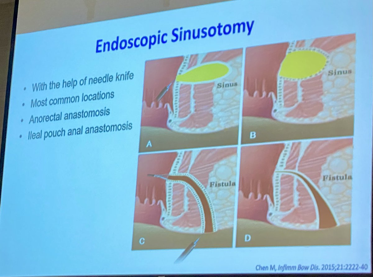 Aline Charabaty, MD, FACG, AGAF (@dcharabaty) on Twitter photo #AHNIBDSummit <a href="/AHNGastro/">AHN Gastroenterology, Hepatology and Nutrition</a>
<a href="/GKochharMD/">Gursimran Kochhar MD</a> pushing the limits of endo management of #IBD complications & the intersection between IBD & therapeutic endo
✅Stricture ✅Fistula ✅Sinus tract ✅Dysplastic lesion & more
His 📹 made my💜 race more than 10 cups☕️! Don’t try this at home! #AHNIBDSummit <a href="/AHNGastro/">AHN Gastroenterology, Hepatology and Nutrition</a>
<a href="/GKochharMD/">Gursimran Kochhar MD</a> pushing the limits of endo management of #IBD complications & the intersection between IBD & therapeutic endo
✅Stricture ✅Fistula ✅Sinus tract ✅Dysplastic lesion & more
His 📹 made my💜 race more than 10 cups☕️! Don’t try this at home!