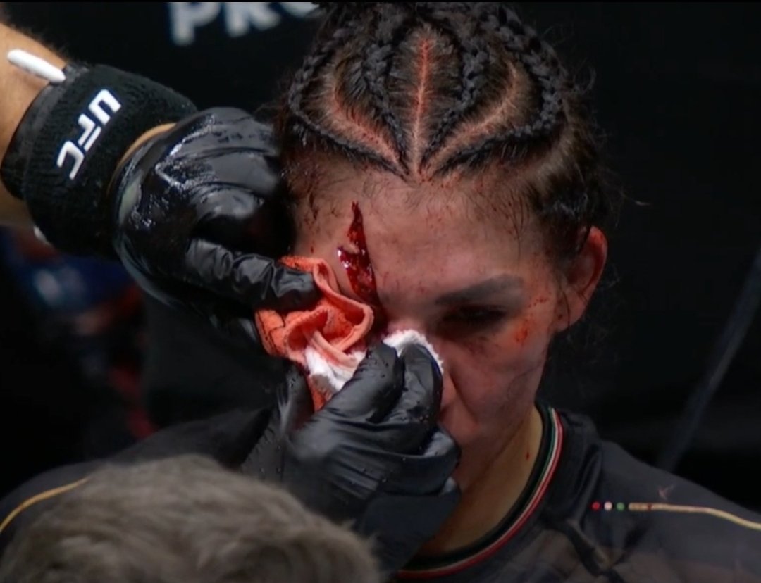 Nate Diaz would have bled out. 

This cut on Aldana is wild. 

#UFC306