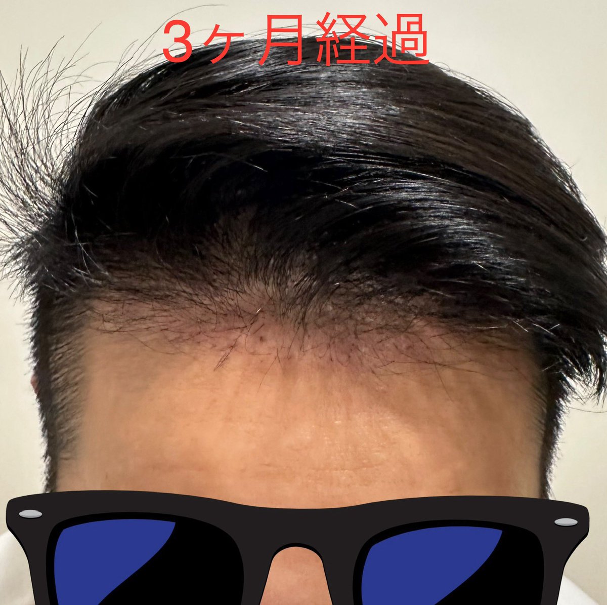 CEO_bodymaker's tweet photo. 【植毛から7.5ヶ月】
今月は少し更新が遅くなりました。植毛後の移植毛はとても順調に成長しています。

最近知人に会った際「若返った？肌が綺麗になった？」と、違和感を感じたみたいでしたが最後まで分からなかったようです。

それだけ自然な変化なのだと思いました。

@pagepagetan
@pasuoat
🙏✨ https://t.co/CxT3J5Pa6v