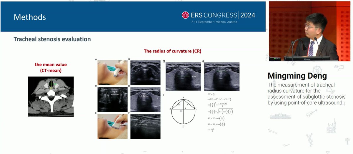 A very interesting Oral presentation at ERS 2024

Measuring Tracheal Dimensions Using POCUS : A Novel Method for Assessing Subglottic and Tracheal Stenosis Based on Tracheal Radius Curvature

Is a reliable and Accurate  tool

Noninvasive and Non radioactive method

Potential