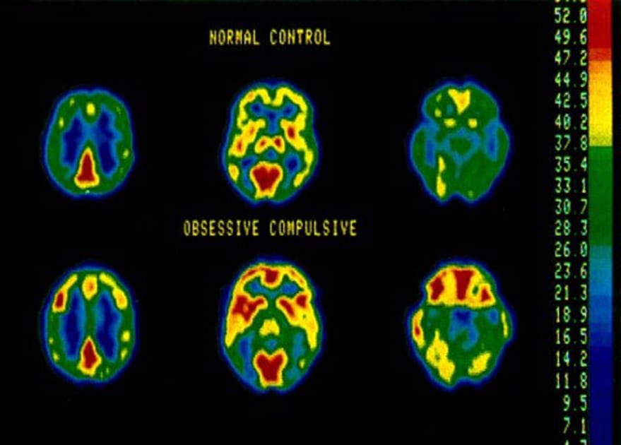 Such a stark difference between normal control and ocd. Just shows how ocd affects the brain, especially the frontal lobe.
