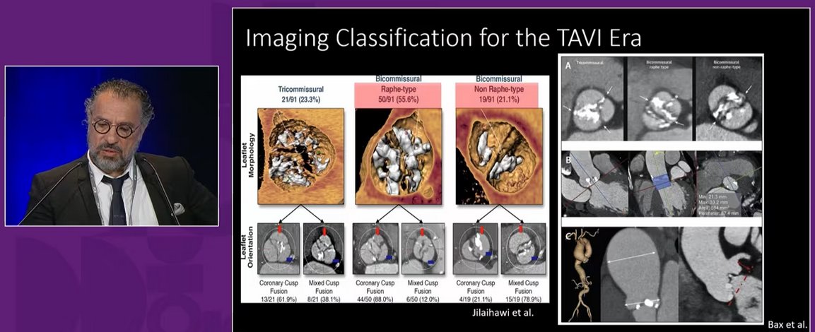 PCRonline 🫀 (@pcronline) on Twitter photo Bicuspid disease - All you (want and) need to know!
Watch this replay 📺 to learn about:
🟣 the anatomical features of bicuspid aortic stenosis🟣the latest post-#TAVI clinical outcomes in bicuspid aortic valves
🟣 key considerations for sizing
🟣 and analyze  self-expanding and Bicuspid disease - All you (want and) need to know!
Watch this replay 📺 to learn about:
🟣 the anatomical features of bicuspid aortic stenosis🟣the latest post-#TAVI clinical outcomes in bicuspid aortic valves
🟣 key considerations for sizing
🟣 and analyze  self-expanding and