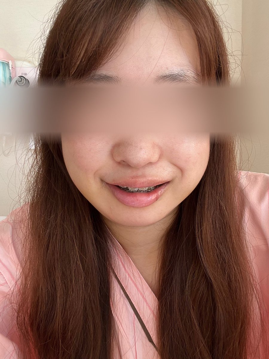 suteki_life2022's tweet photo. 術後4日目でまだまだ腫れてますが、笑うとこんな感じです。ガミースマイルが改善されるとだいぶ印象変わりますね‥面長感と老けた印象も改善されてる気がします
#ルフォー #ssor #両顎手術 (術後&術前) https://t.co/ezwKnsCbwv