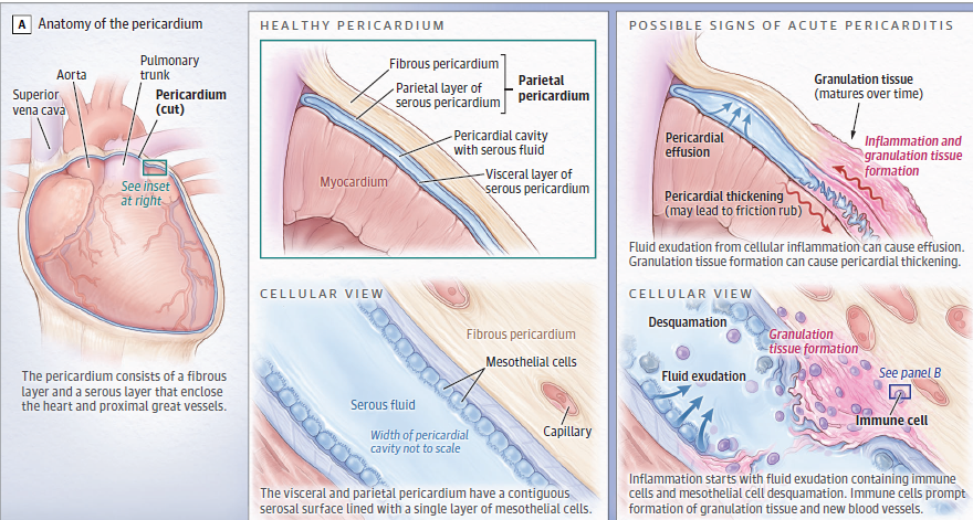 cardioteca's tweet photo. 🆕 Pericarditis: Diagnóstico, estratificación del riesgo y tratamiento.

📕 JAMA
📁  https://t.co/Rpj30dtN4R https://t.co/d4t0NIpJOy