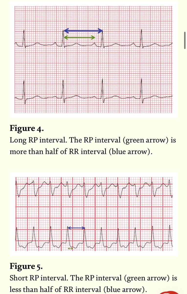 macr23BvS's tweet photo. 🧵 de intervalos, ondas y patrones de EKG q no les enseñan en sus casas, turnos, pases de visita etc

Intervalo RP 
(inicio de QRS hasta finalizar la onda P)

Sirve para difer. Taquicardia supraventri en RP corto vs RP largo 
RP corto= origen nodal/AV
RP largo= origen no nodal https://t.co/Qphg1k64Xc