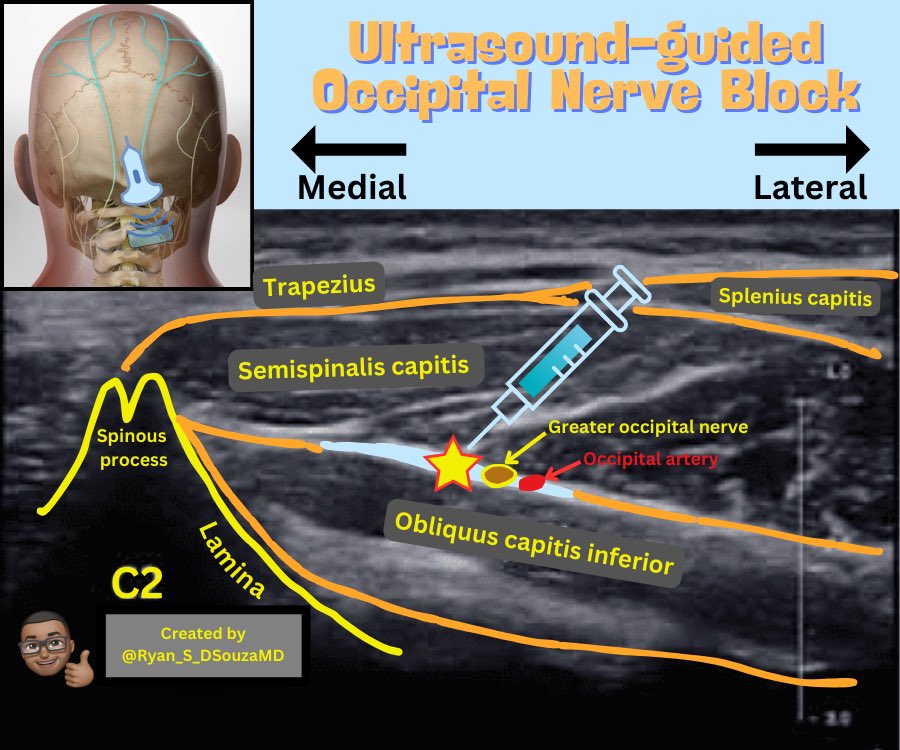 Ryan D'Souza, MD (@ryan_s_dsouzamd) on Twitter photo Check out this new infographic🩻 
One of my favorite blocks to perform - ultrasound-guided greater occipital nerve block. This graphic shows the important landmarks and ultrasound probe position to perform this block.🧵 Check out this new infographic🩻 
One of my favorite blocks to perform - ultrasound-guided greater occipital nerve block. This graphic shows the important landmarks and ultrasound probe position to perform this block.🧵