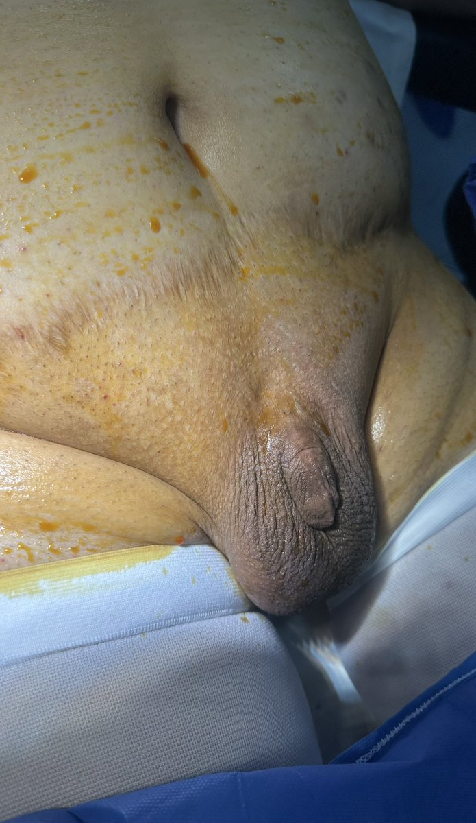 drllaque's tweet photo. Resultados inmediatos de Faloplastia de aumento, logrando mejorar tanto longitud como grosor 🍆🔥. Qué creen que dirá el paciente cuando quitemos el vendaje y logre ver el resultado final? 
#agrandamientodepene #engrosamientodepene #unoscmdemas https://t.co/U0dpxKz75w