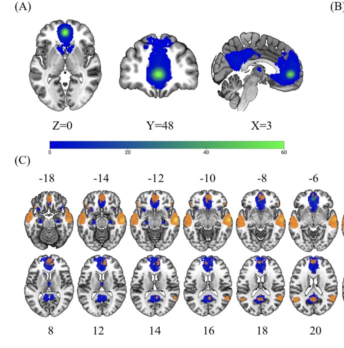 bn_becker's tweet photo. we find enhanced reactivity in the #ACC and #mPFC with both regions coupling with the #DMN default mode network suggesting excessive #empathic reactivity in mental disorders. Congrats to He Jiangxian ; ) https://t.co/vt77x4AHam