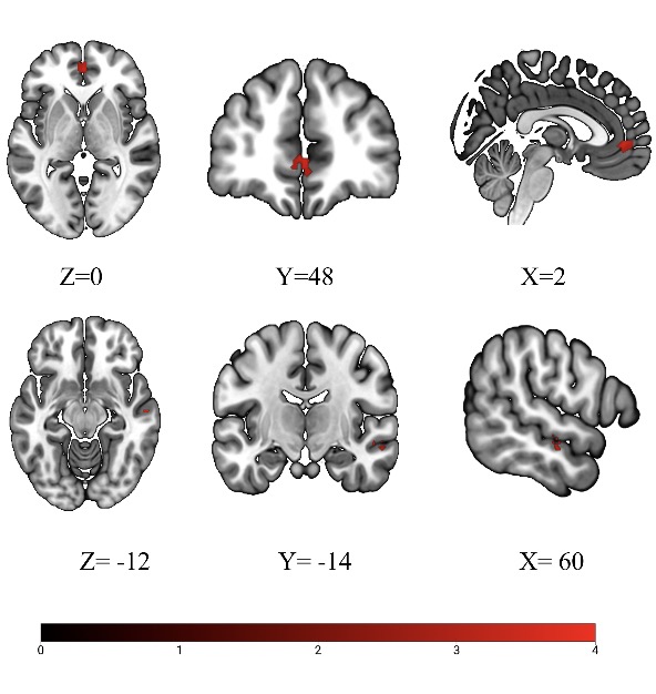 bn_becker's tweet photo. we find enhanced reactivity in the #ACC and #mPFC with both regions coupling with the #DMN default mode network suggesting excessive #empathic reactivity in mental disorders. Congrats to He Jiangxian ; ) https://t.co/vt77x4AHam