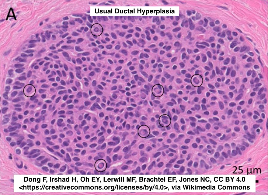 Path4People's tweet image. 🔬 Usual Ductal Hyperplasia (Breast)

🔬In addition to the windswept architecture and slit like spaces, another clue for Usual Ductal Hyperplasia ⬇️ 
👀👀Intranuclear Cytoplasmic Pseudoinclusion👀 👀 

 #pathx #path4people #breastpath #pathagonia #breastx #medx #pathx #pathology