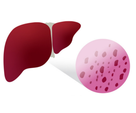 #Hepatitis_B_Virus (HBV) a highly contagious liver infection that can cause chronic liver disease, liver cancer, and death. #Vaccination has been instrumental in reducing transmission, but global eradication remains a goal. #JLR