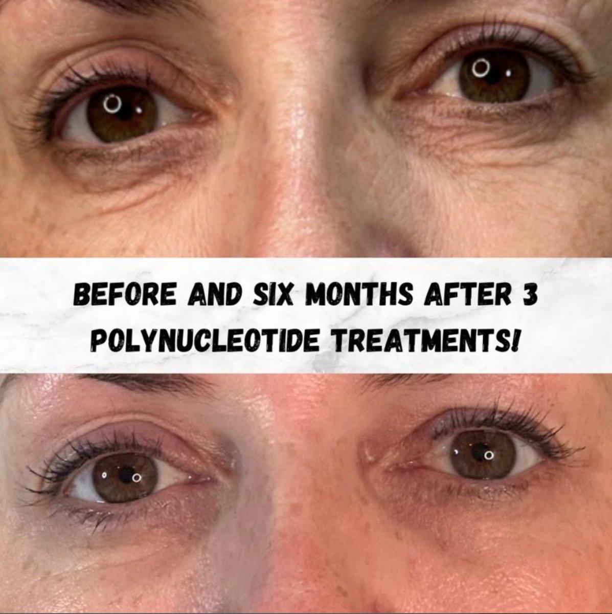 ✨ Say goodbye to tired eyes &amp; hello to refreshed radiance with #Polynucleotides! 🌟 This injectable bio-stimulator helps reduce wrinkles &amp; restore a youthful glow under the eyes. Ready for a transformation? Book a free consultation today! 💖

glendental.co.uk/facial-aesthet…