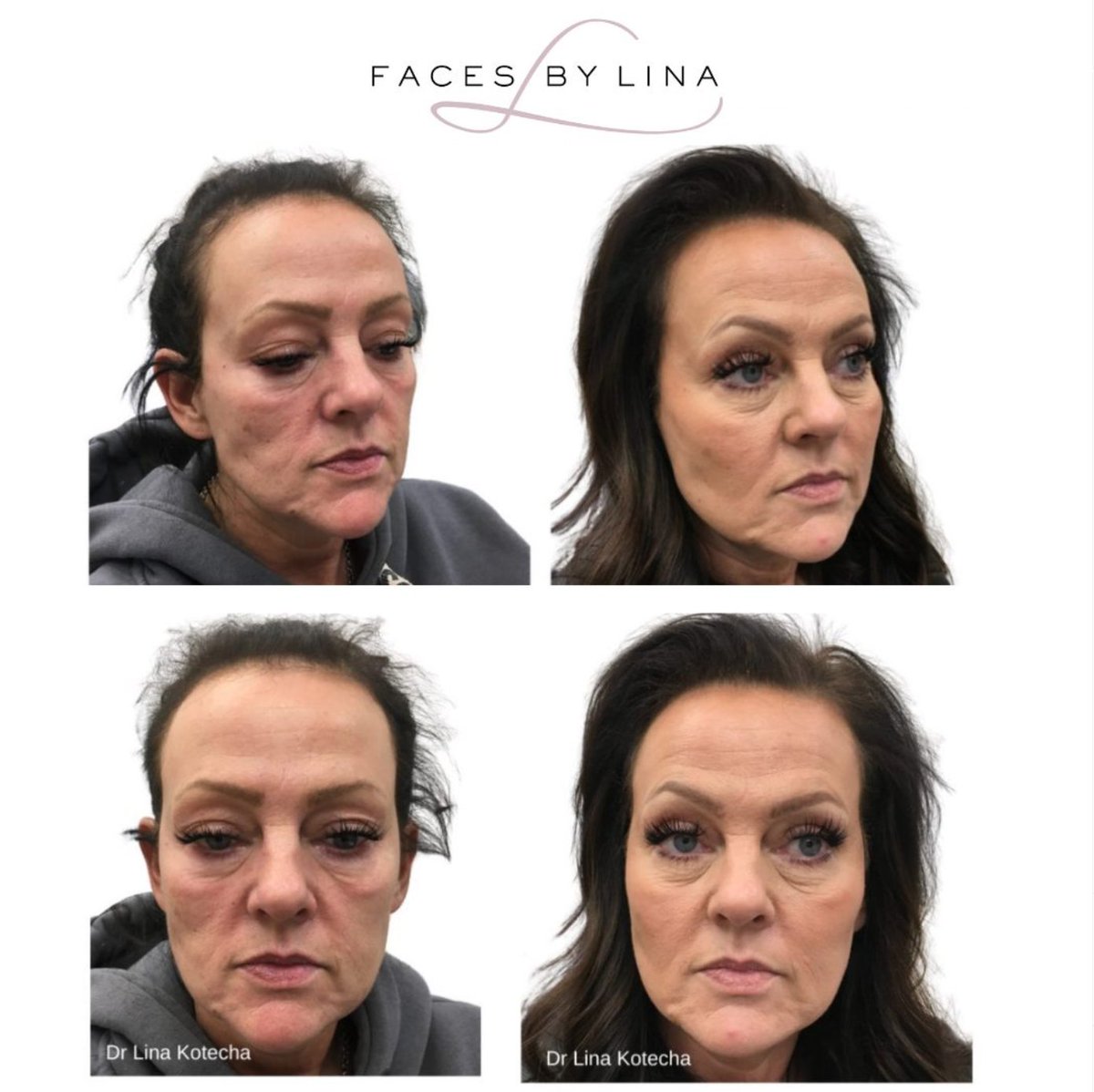 "Years younger!" We love hearing how happy our clients are with their results. 🙌✨ This lovely client shared her #BeforeAndAfter showing the amazing transformation from PDO Threads &amp; dermal filler. We're thrilled with the results, and so is she! 💖 #FacialAesthetics