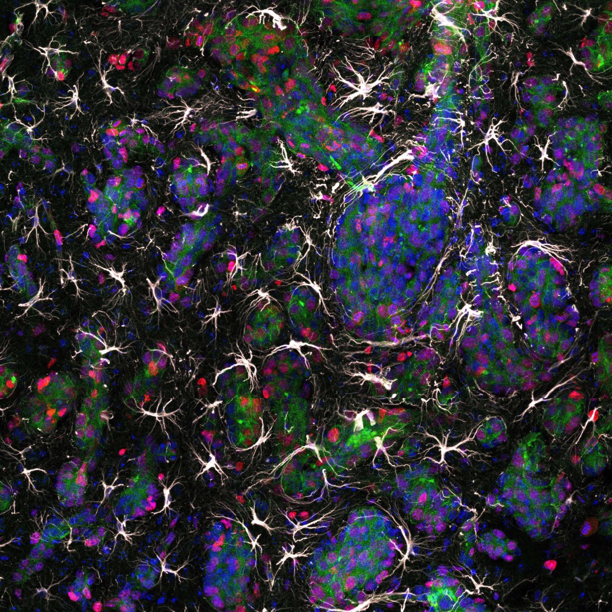 #SciencePhoto_IN
"Spiders weaving cellular cocoons"
Author: Carlos García @cgmolinero00
Lab: Dr. Angela Nieto <a href="/NietoAngela/">Angela Nieto</a>
"Image of brain metastasis (clusters of cells, blue) expressing a membrane receptor (HER2, green) and surrounded by astrocytes (GFAP, white). <a href="/zeiss_micro/">ZEISS Microscopy</a>."