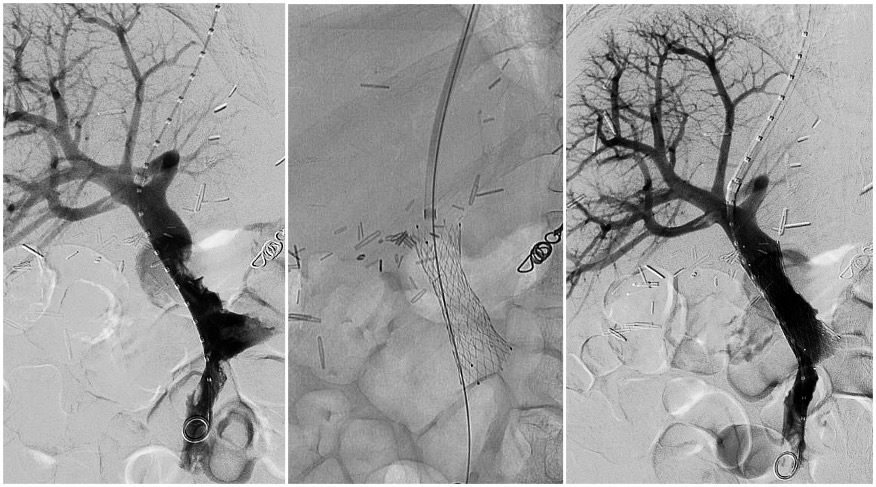 Jeffrey F. B. Chick, MD, MPH (@chickvir) on Twitter photo Designed for caval and extremity deep vein use, dedicated venous stents (Venovo and Abre) aim to provide a balance of flexibility, radial force, and crush resistance and may prove useful for splanchnic vein reconstructions.
<a href="/cirsesociety/">CIRSE</a> <a href="/CVIR_Journal/">CVIR Journal</a> <a href="/cvirendo/">CVIR Endovascular (Jim Reekers, Editor-in-Chief)</a> <a href="/UWRadiology/">UW Radiology</a> Designed for caval and extremity deep vein use, dedicated venous stents (Venovo and Abre) aim to provide a balance of flexibility, radial force, and crush resistance and may prove useful for splanchnic vein reconstructions.
<a href="/cirsesociety/">CIRSE</a> <a href="/CVIR_Journal/">CVIR Journal</a> <a href="/cvirendo/">CVIR Endovascular (Jim Reekers, Editor-in-Chief)</a> <a href="/UWRadiology/">UW Radiology</a>