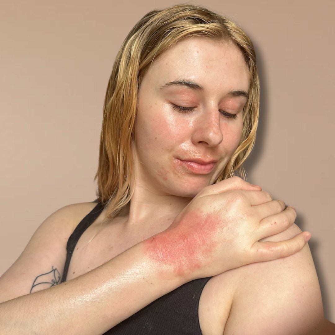 As part of #NationalEczemaWeek, I am delighted to have teamed up with <a href="/westlabsalts/">@westlabsalts</a> to join them on our shared mission to #NormalizeNormalSkin, raising awareness for people like me with visible skin conditions. 

❤️‍🩹 See More >> bit.ly/3TxHgtf