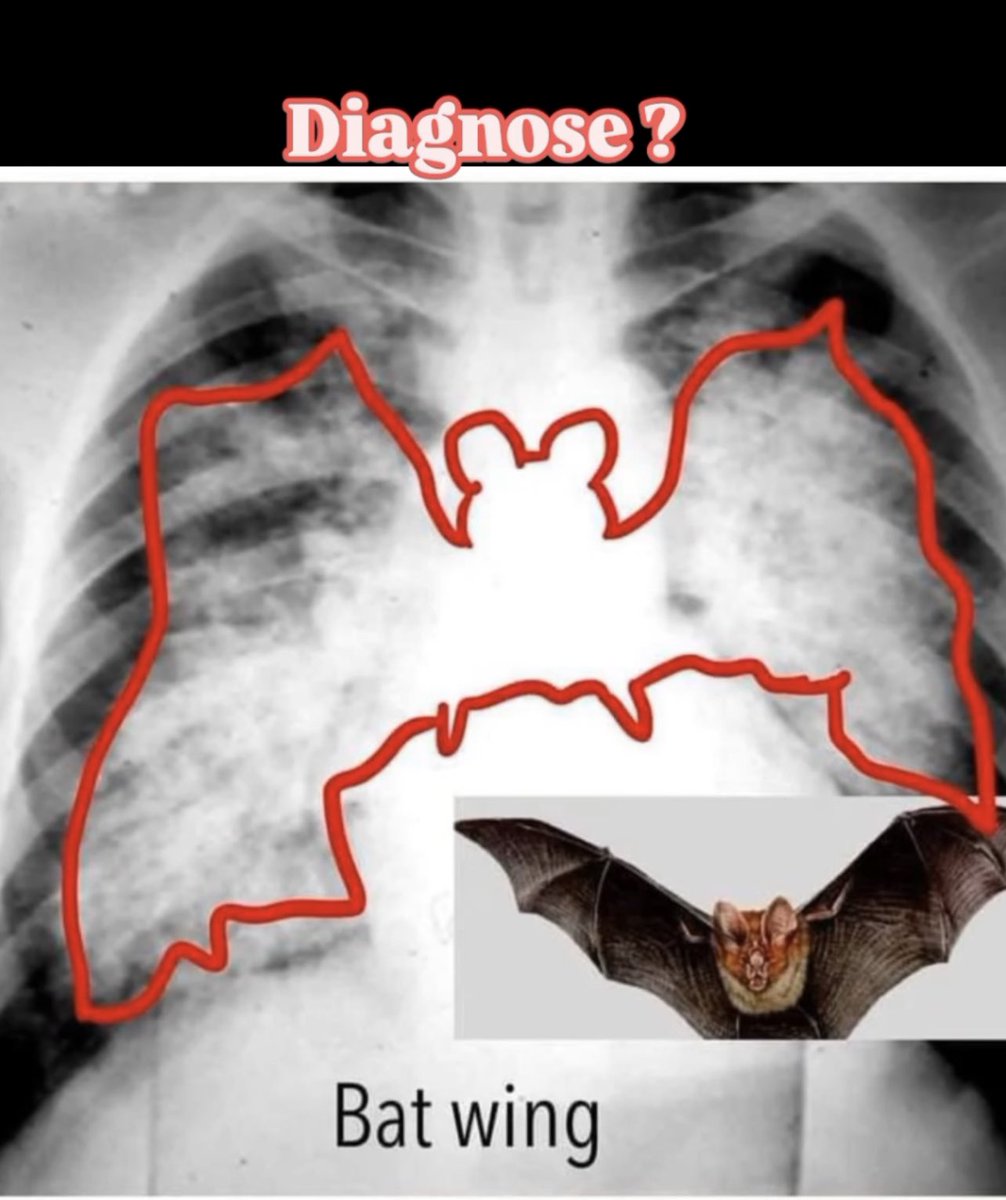 DrMedica_13's tweet image. Clinical Challenge 🌟🍁
⭐︎⭐︎⭐︎
#Diagnosis 
#MedEd 
#MedX 
#Q_Pearls