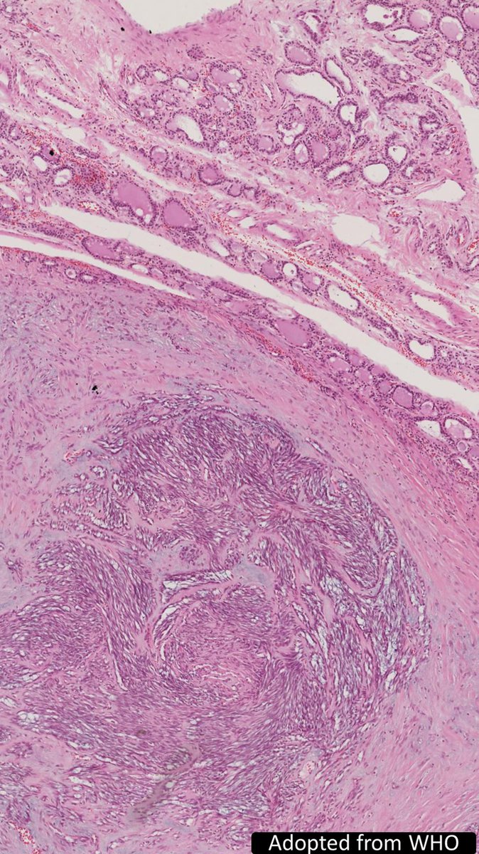DrCycloPath's tweet image. Thyroid mass, 1st impression?
A) Synovial sarcoma
B) Intrathyroid thymoma
C) Spindle epithelial tumor with thymus-like elements
🔬tumourclassification.iarc.who.int/Viewer/Index2?…
#BSTPath #EndoPath #PathTwitter #pathology
