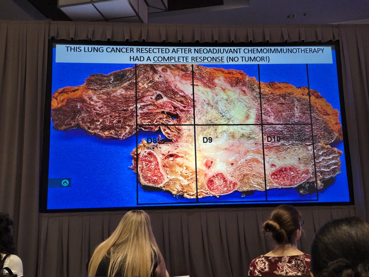 PathAssistant's tweet image. Great pulmonary pathology  lecture by Dr. Sanjay Mukhopadhyay #AAPAfall24