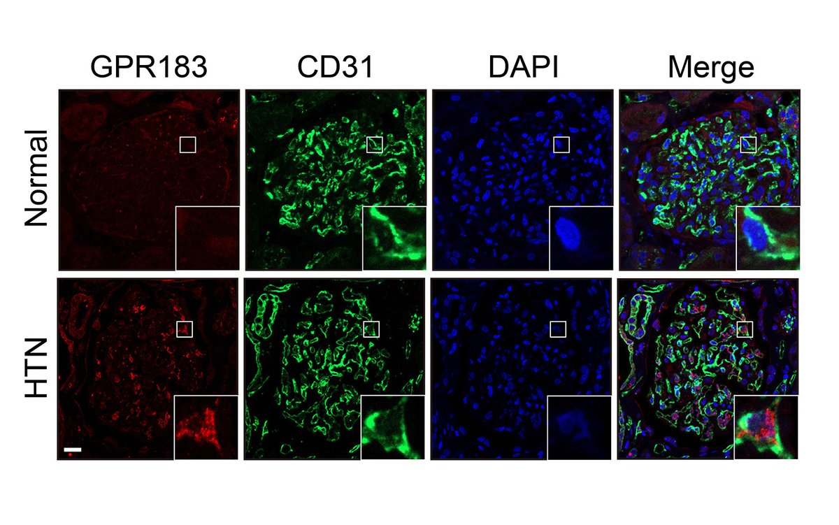 CircRes's tweet photo. Chu & colleagues found that #oxysterol sensing through #GPR183 triggers endothelial #senescence & injuries via altering #circadian signaling in #hypertension. Learn more at https://t.co/wD1R99xLCE https://t.co/AsYZT6aSJn
