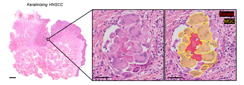 ElizSMcKenna's tweet photo. Now online in @CD_AACR: TREM2-expressing Multinucleated Giant Macrophages Are a Biomarker of Good Prognosis in Head and Neck Squamous Cell Carcinoma - by @GregoireGessain @FGinhoux and colleagues https://t.co/sPoUqHubgT @GustaveRoussy https://t.co/Oq3x28CGFm