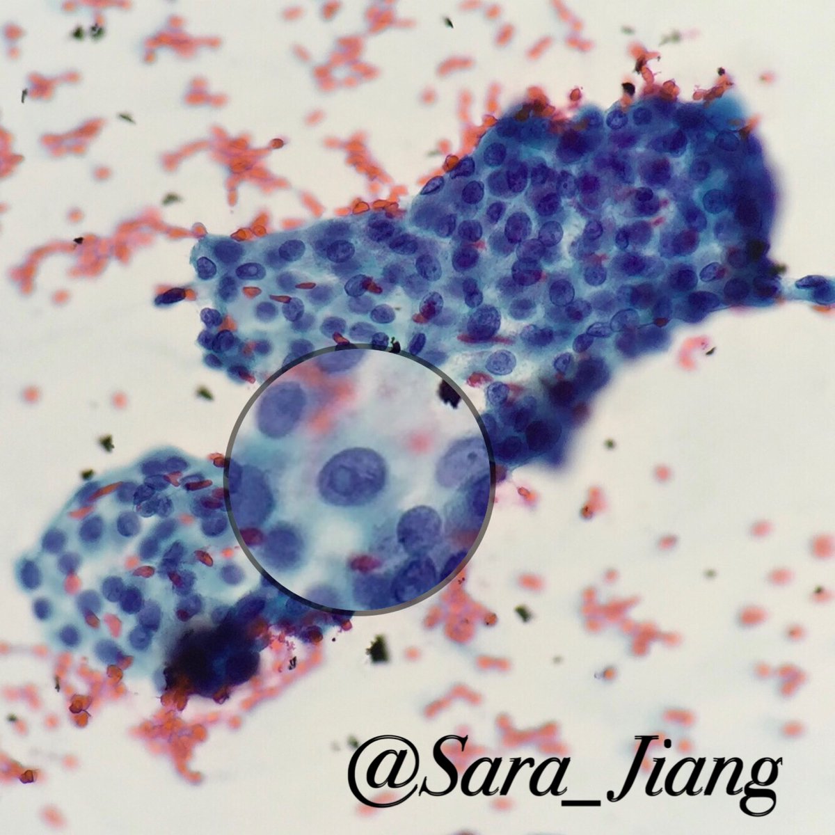 September is #ThyroidCancer Awareness Month! 
Pictured is the most common thyroid cancer, Papillary Thyroid Carcinoma, seen on cytology from fine needle aspiration
Inset shows intranuclear cytoplasmic pseudoinclusion which along with grooves is a characteristic nuclear feature
