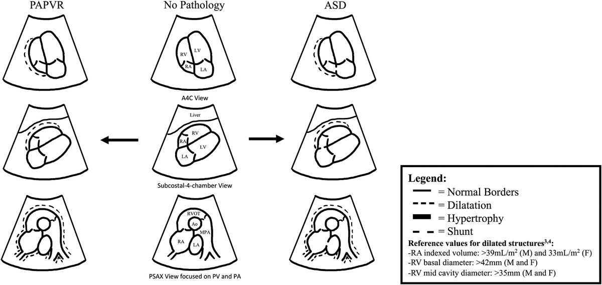 📔 Presenting a simplified approach to echocardiography for structural cardiac shunts based on patterns of cardiac remodelling 👉cjcopen.ca/article/S2589-… #CJCO #OpenAccess