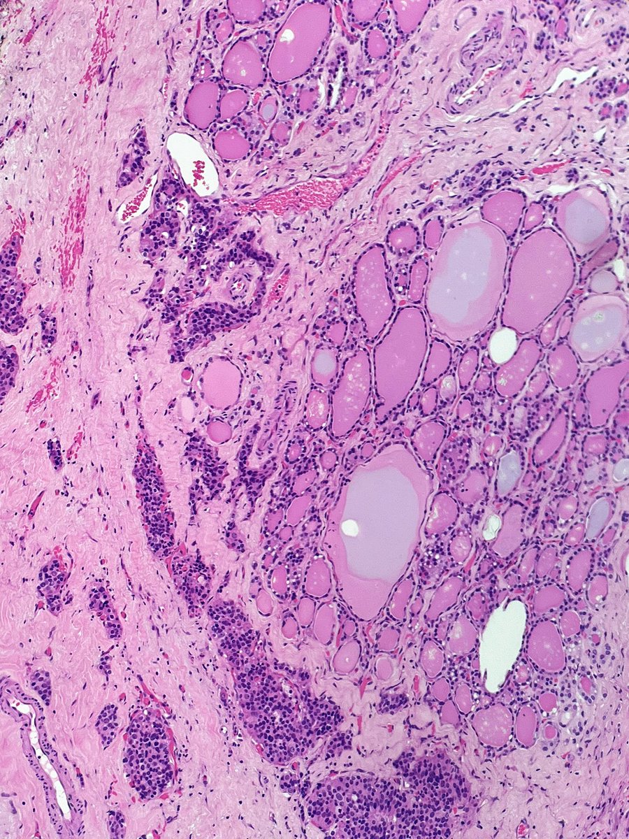 Thyroidectomy from 70 yo F

What’s going on?
How would you stage this?

#PathX #COTW