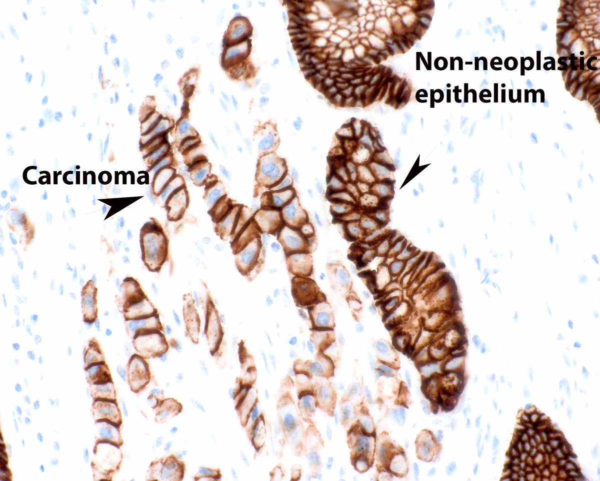 Claudin 18.2 immunohistochemistry is new for gastric and esophageal adenocarcinomas.  Benign gastric mucosa is the internal positive control.  2+-3+ membrane staining in ≥75% of tumor cells is the cutoff for use of  anti-CLDN18.2 (zolbetuximab). #UMiamiPath PMID: 39098518.