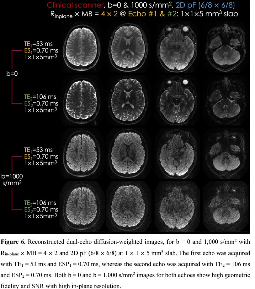 Frank Yeh (@fangchengyeh) on Twitter photo Likely a technique that is going to change dMRI
arxiv.org/abs/2409.07375
My two cents:
1. Performance on high-b and high-field scanners is the key (not shown in the work)
2. No need for TOPUP/EDDY in the future.
by <a href="/berkin_bilgic/">Berkin Bilgic</a> <a href="/Yogi_Spoke/">Yogesh Rathi</a> <a href="/nastasiayendiki/">Anastasia Yendiki</a> <a href="/SusieHuangMDPhD/">Susie Huang</a> Likely a technique that is going to change dMRI
arxiv.org/abs/2409.07375
My two cents:
1. Performance on high-b and high-field scanners is the key (not shown in the work)
2. No need for TOPUP/EDDY in the future.
by <a href="/berkin_bilgic/">Berkin Bilgic</a> <a href="/Yogi_Spoke/">Yogesh Rathi</a> <a href="/nastasiayendiki/">Anastasia Yendiki</a> <a href="/SusieHuangMDPhD/">Susie Huang</a>