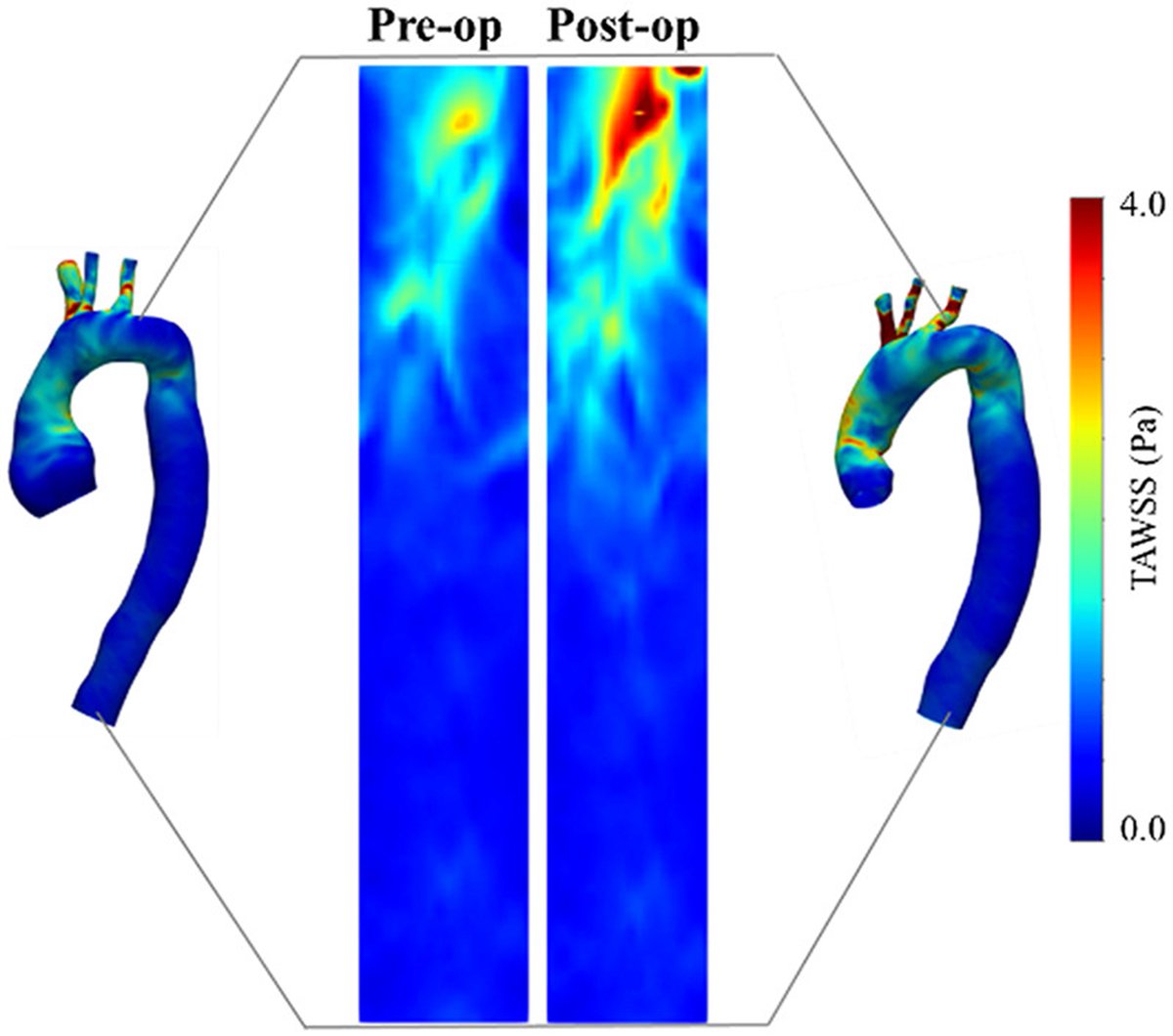 AATS (@aatshq) on Twitter photo How can surgeons reduce the risk of acute type B aortic dissection in patients with Marfan who undergo the David procedure? This study in #JTCVS Open looks at hemodynamic changes in the descending aorta post surgery: doi.org/10.1016/j.xjon…
<a href="/jenn_cy_chung/">Jennifer Chung</a> <a href="/OuzounianMD/">Maral Ouzounian</a> How can surgeons reduce the risk of acute type B aortic dissection in patients with Marfan who undergo the David procedure? This study in #JTCVS Open looks at hemodynamic changes in the descending aorta post surgery: doi.org/10.1016/j.xjon…
<a href="/jenn_cy_chung/">Jennifer Chung</a> <a href="/OuzounianMD/">Maral Ouzounian</a>