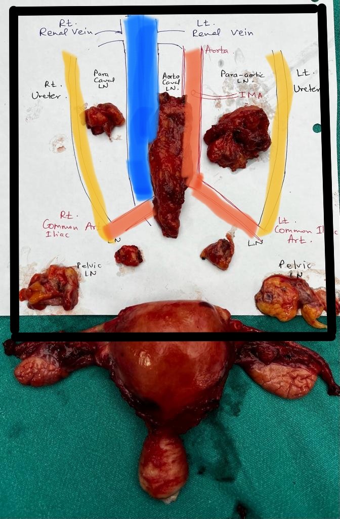 drchandrakant_m's tweet photo. 🔪 Open RPLND done in case of Ca Endometrium.
Post op recovery - Uneventful 
🏥 Intraop call from an OBGY Colleague 
👨🏻‍⚕️ Team Urology @AIIMSNagpur https://t.co/CUGpmDj8Gs