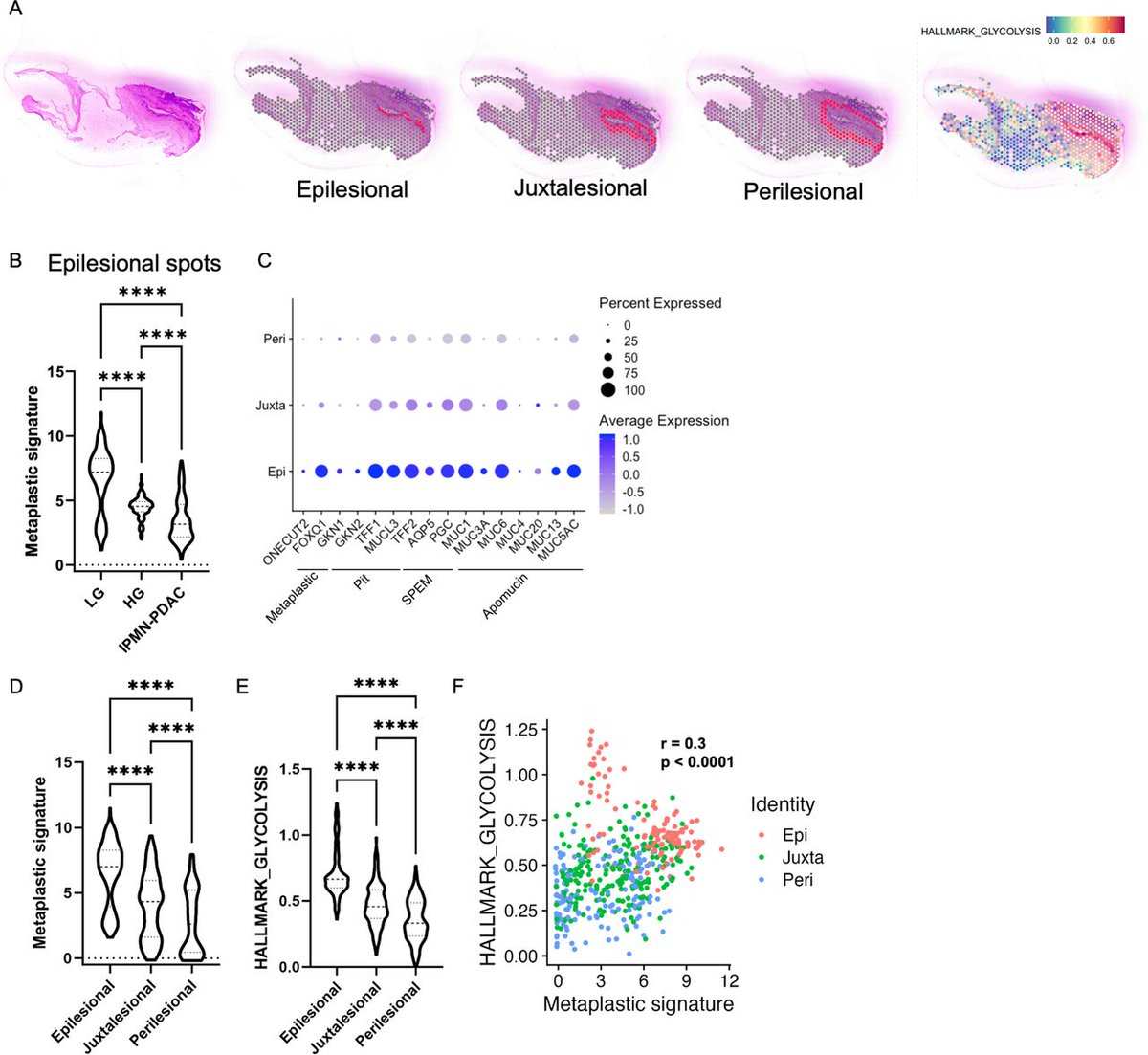 Gut Journal (@gut_bmj) on Twitter photo Read the #GUTOnline paper by Makino et al on
"Metabolic reprogramming by mutant GNAS creates an actionable dependency in intraductal papillary mucinous neoplasms of the pancreas" via
bit.ly/4d6O8F8
<a href="/FredrikThege/">Fredrik Thege</a> <a href="/Aiims1742/">Anirban Maitra</a> <a href="/MDAndersonNews/">MD Anderson Cancer Center</a> #IPMN Read the #GUTOnline paper by Makino et al on
"Metabolic reprogramming by mutant GNAS creates an actionable dependency in intraductal papillary mucinous neoplasms of the pancreas" via
bit.ly/4d6O8F8
<a href="/FredrikThege/">Fredrik Thege</a> <a href="/Aiims1742/">Anirban Maitra</a> <a href="/MDAndersonNews/">MD Anderson Cancer Center</a> #IPMN
