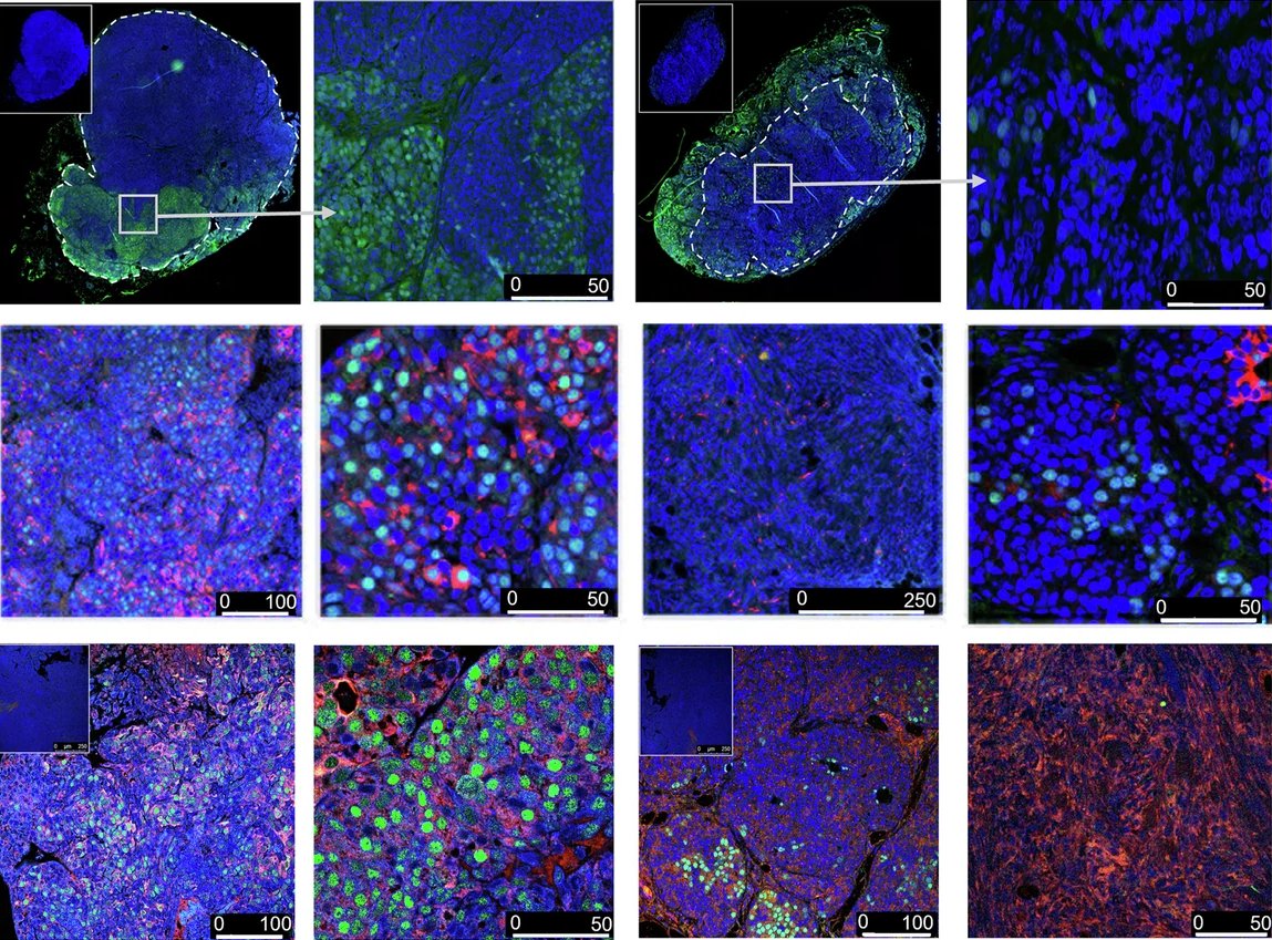 MammaryCell's tweet photo. A team from @huntsmancancer demonstrates that the cell surface glycoprotein Mcam maintains the tumorigenic luminal progenitor-like #epithelial cell state, leading to basal-like #mammary cancers.
π Full study in @Nature_NPJ: https://t.co/3m1esMgMNR https://t.co/KXKFVLn6hO