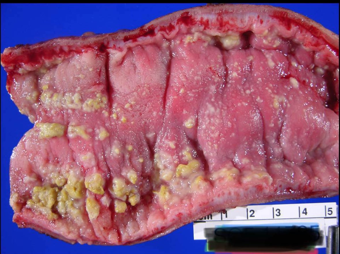 smlungpathguy's tweet image. 7. Pseudomembranous colitis #gipath #pathology #grosspath @danielsode