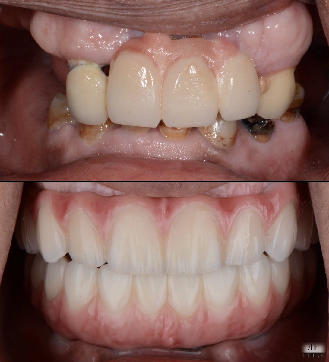 حالة اعادة تاهيل للفكين
.
تم عمل الزرعات مع <a href="/Draalhumaidan/">Dr.AAAlhumaidan</a> 
.
<a href="/dentalhousec/">Dental House Clinics</a> 
.
#السعودية #ابتسامة #عيادات_الخبر #تجميل_اسنان #_عيادات_اسنان #الخبر #الدمام
#صباح_الخير