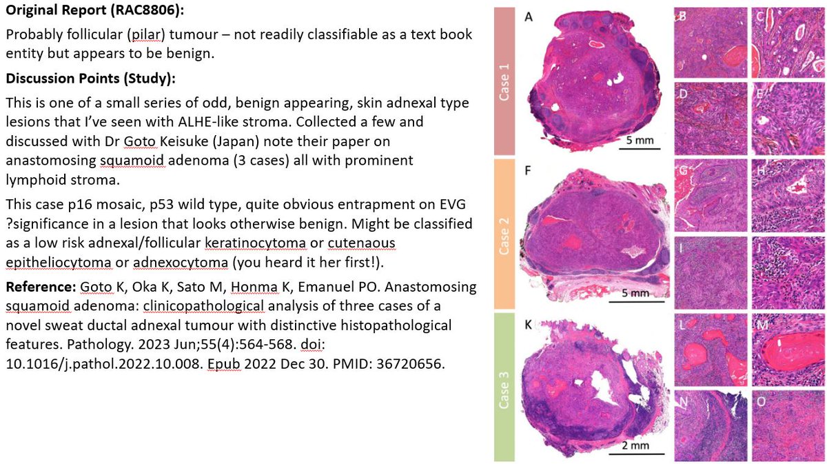 RACARR51's tweet photo. RAC8806: p16 mosaic, p53 wild type, entrapment present on EVG. My Dx: Probably a benign follicular keratinocytoma/cutaneous follicular adnexocytoma (? variant benign variant of (infundibular-tricholemmal tumour) with ALHE-like stroma (collected a few of the latter). #NewEntity https://t.co/fZauG2M0ch