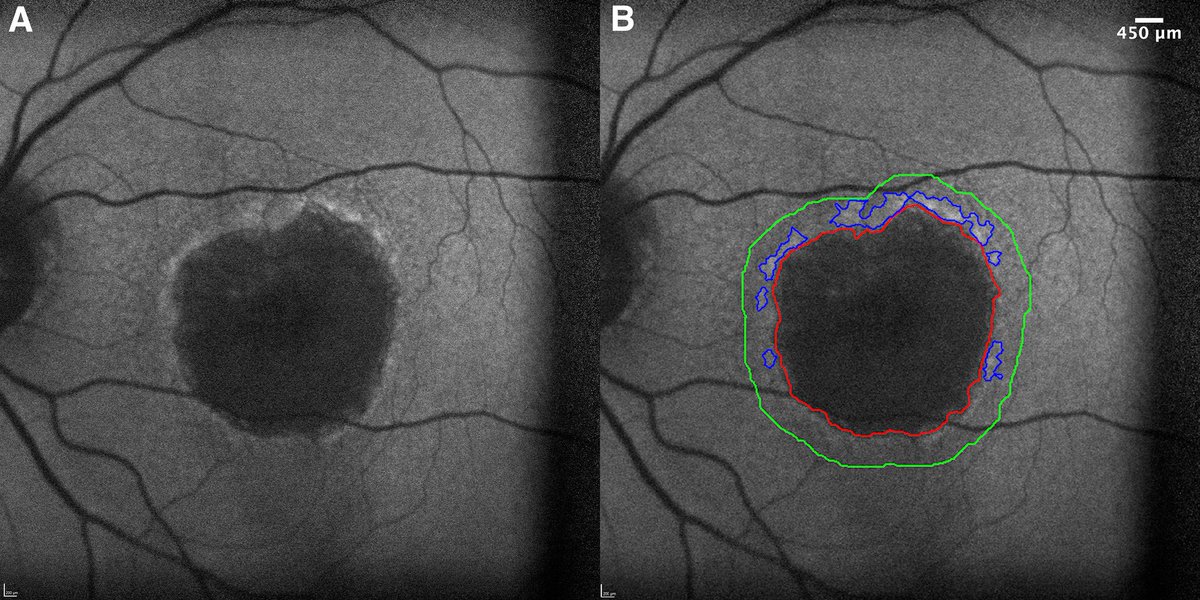 Our latest study <a href="/AAOjournal/">Ophthalmology</a> shows that increased baseline hyperautofluorescent signals (rim area focal hyperautofluorescence) is linked to faster geographic atrophy progression, particularly in small to medium-sized lesions. #AAO #Ophthalmology #GA ophthalmologyscience.org/article/S2666-…