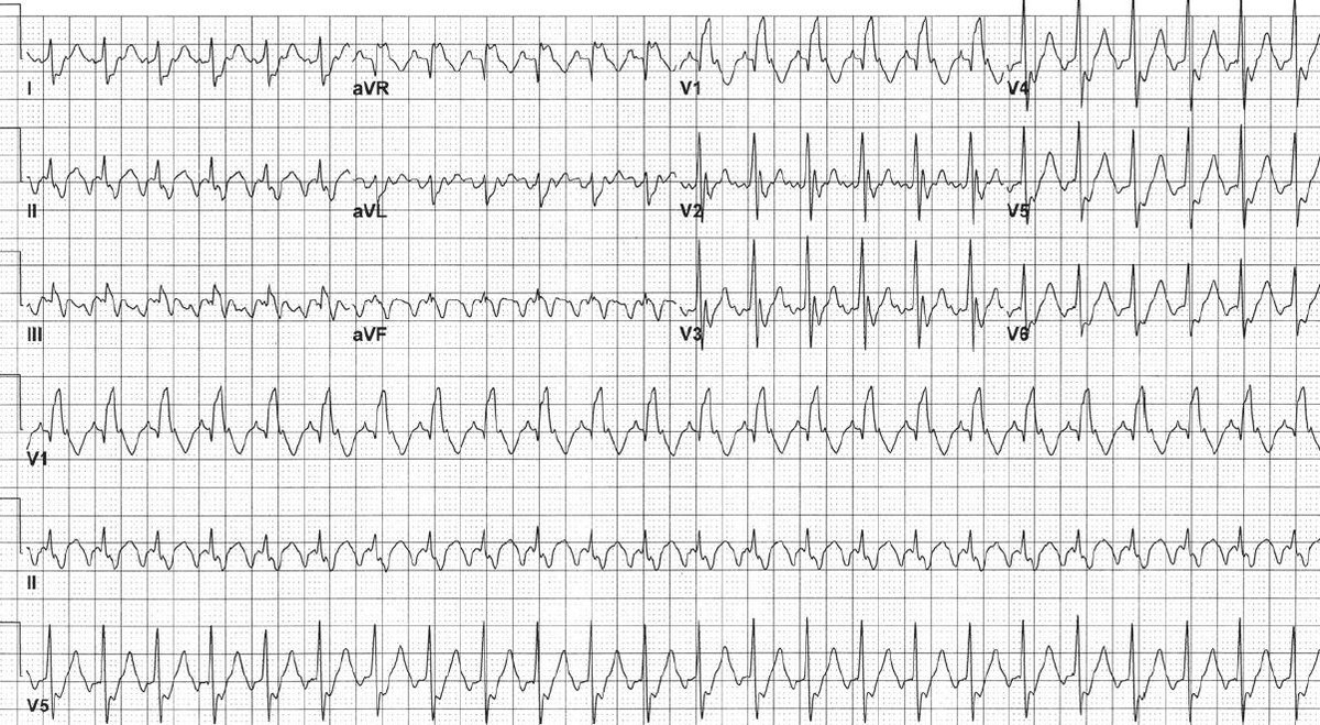 A 55-year-old woman presents with palpitations and dyspnea.
- What’s the rhythm ?

➡️ Interpretation and Answer: manualofmedicine.com/ecgs/ecg-case-…

#medtwitter #foamed #cardioed