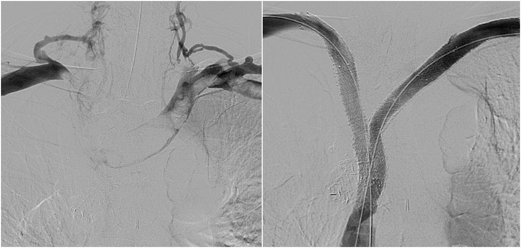 Jeffrey F. B. Chick, MD, MPH (@chickvir) on Twitter photo Dedicated venous stents are approved for treatment of iliofemoral venous occlusive disease, but may be used in the upper extremity and thoracic central veins with excellent technical and clinical successes.
<a href="/cirsesociety/">CIRSE</a> <a href="/CVIR_Journal/">CVIR Journal</a> <a href="/JVIRmedia/">JVIR</a> <a href="/cvirendo/">CVIR Endovascular (Jim Reekers, Editor-in-Chief)</a> Dedicated venous stents are approved for treatment of iliofemoral venous occlusive disease, but may be used in the upper extremity and thoracic central veins with excellent technical and clinical successes.
<a href="/cirsesociety/">CIRSE</a> <a href="/CVIR_Journal/">CVIR Journal</a> <a href="/JVIRmedia/">JVIR</a> <a href="/cvirendo/">CVIR Endovascular (Jim Reekers, Editor-in-Chief)</a>
