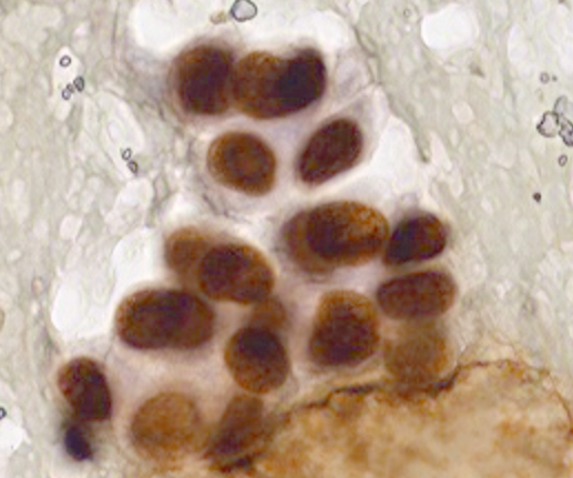mdlozanoe's tweet photo. Pleural effusion, lung adenocarcinoma. I just want to share the beauty of TTF1 performed on Papanicolaou-stained smears. Thanks to my amazing cytology and immunocytochemistry technicians; they work wonders!!πππ―πͺ #Cytotechnicians #PathTech #CytoPath @cytopathology @IACytology https://t.co/rlfFAk3y0r