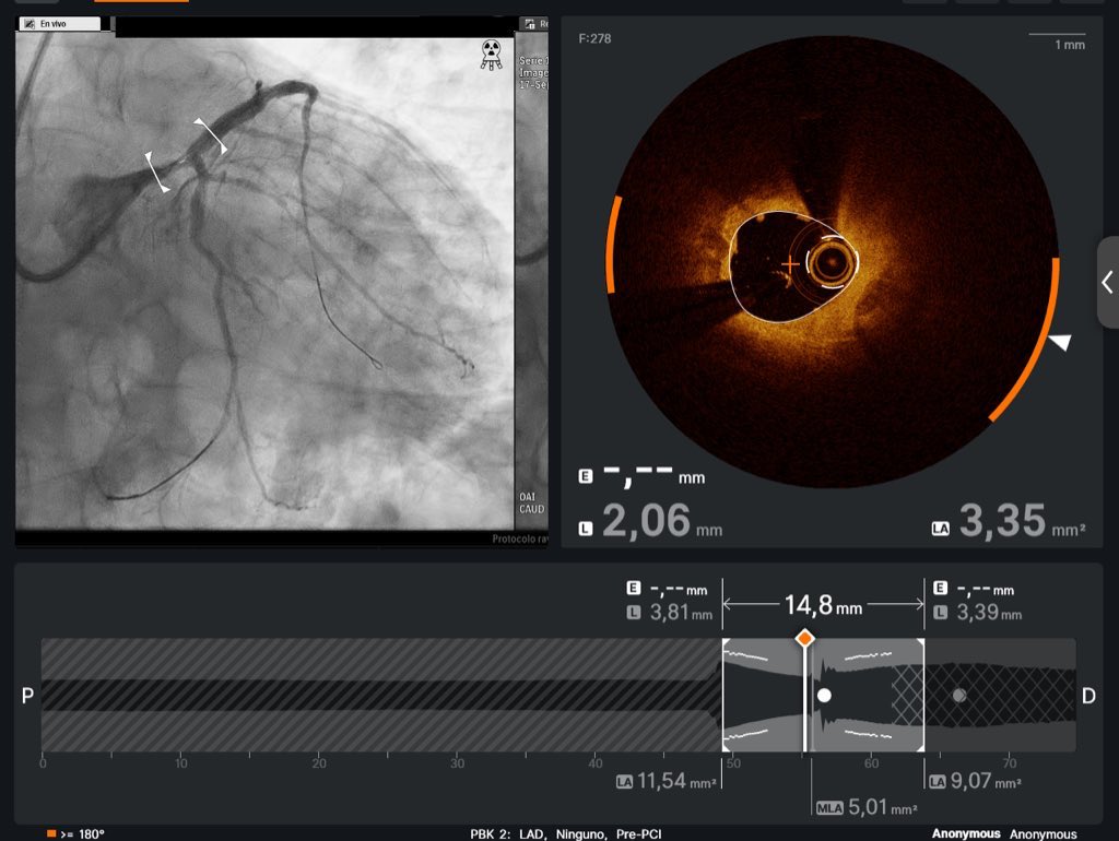 Tercer paciente incluido en el Hospital Juan Ramón Jiménez en el estudio Emperatriz! 
OCT vs IVUS en la evaluación de TCI. 
#OCT #IVUS #TCI
