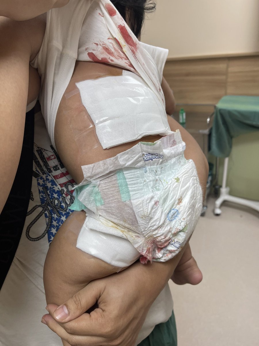 katyaow's tweet photo. Happy 10months old sa bravee baby ko! Pero veru painful ang ngyari kahapon dahil he was bitten hard by our own cardog😭 2mins lang ako umalis and pinaiwan ko sa helper and wla naman daw gngwa baby ko dinaganan and ilang kagat ang natamo malala ung sa likod. ThankYou Lord!❤️ https://t.co/aLsk4Dx8i5