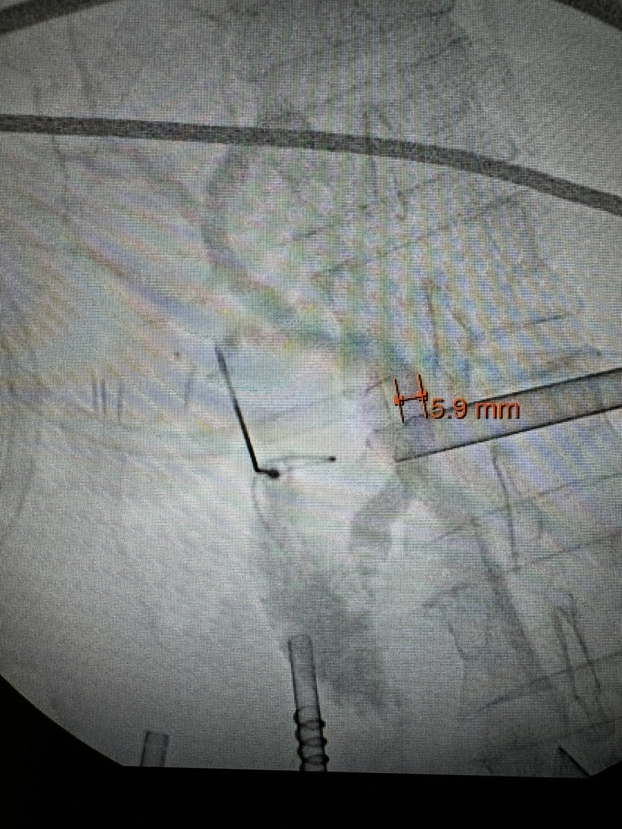 Shiva Jayaraman (@cutitoutpodcas1) on Twitter photo Great example of ideal case of transcystic lapCBDE. ERCP not ideal for this pt& avoidable in general. CBD not really dilated. Don’t want to do a choledochotomy. TBH, it’s tough to manage looping and some set up stuff; training and coaching key. <a href="/SAGES_Updates/">SAGES is in Tampa in 2026!</a> <a href="/CAGS_ACCG/">Cdn General Surgeons</a> <a href="/IHPBA/">IHPBA</a> Great example of ideal case of transcystic lapCBDE. ERCP not ideal for this pt& avoidable in general. CBD not really dilated. Don’t want to do a choledochotomy. TBH, it’s tough to manage looping and some set up stuff; training and coaching key. <a href="/SAGES_Updates/">SAGES is in Tampa in 2026!</a> <a href="/CAGS_ACCG/">Cdn General Surgeons</a> <a href="/IHPBA/">IHPBA</a>