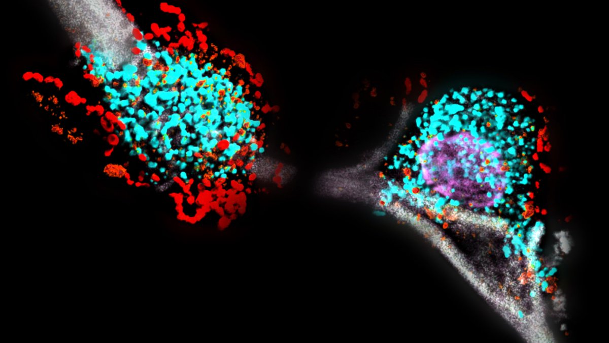ChariteBerlin's tweet photo. 🦠#Pneumococci - the main cause of #pneumonia - damage the lungs differently than previously thought. As researchers from #CharitéBerlin have now shown, the bacteria acidify their environment and thus disintegrate the tissue barrier. 👉https://t.co/NUBQOWthNp https://t.co/aEMeZsiNEY