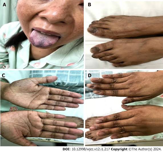 kolla_bharathi's tweet image. Diagnosis ? Probable cause 
Clue - infectious cause ! 
#MedTwitter 
#endotwitter