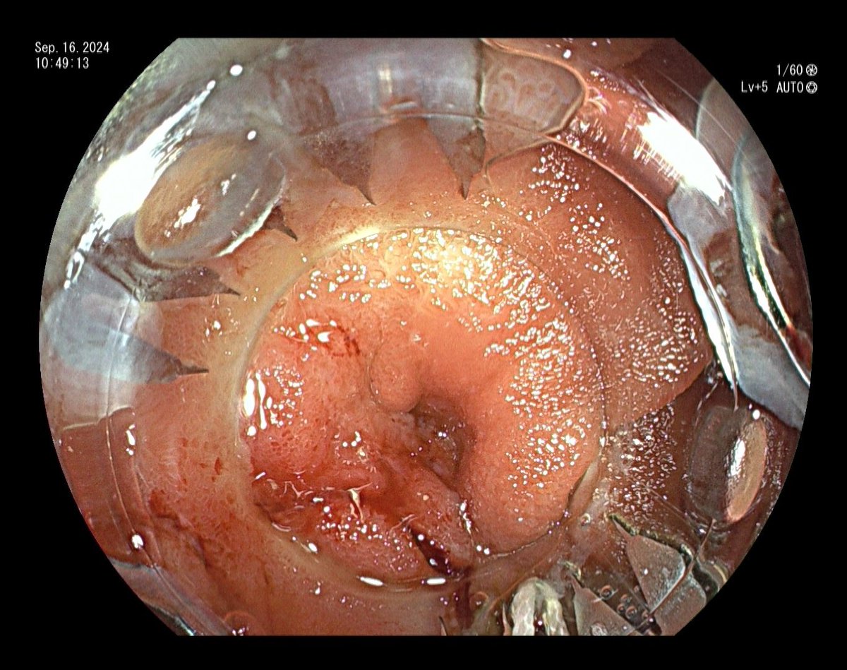 YeseongDavid's tweet photo. Pt with gastric adenocarcinoma s/p subtotal gastrectomy, developed J tube enterocutaneous fistula. Closed endoscopically with Ovesco OTSC. Can be hard to suction up the fistula into cap sometimes due to underlying fibrosis, what are your tricks? https://t.co/IZopN08Dpp