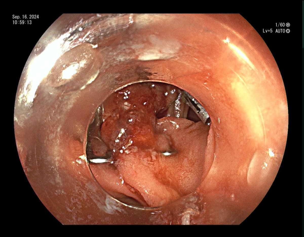 YeseongDavid's tweet photo. Pt with gastric adenocarcinoma s/p subtotal gastrectomy, developed J tube enterocutaneous fistula. Closed endoscopically with Ovesco OTSC. Can be hard to suction up the fistula into cap sometimes due to underlying fibrosis, what are your tricks? https://t.co/IZopN08Dpp