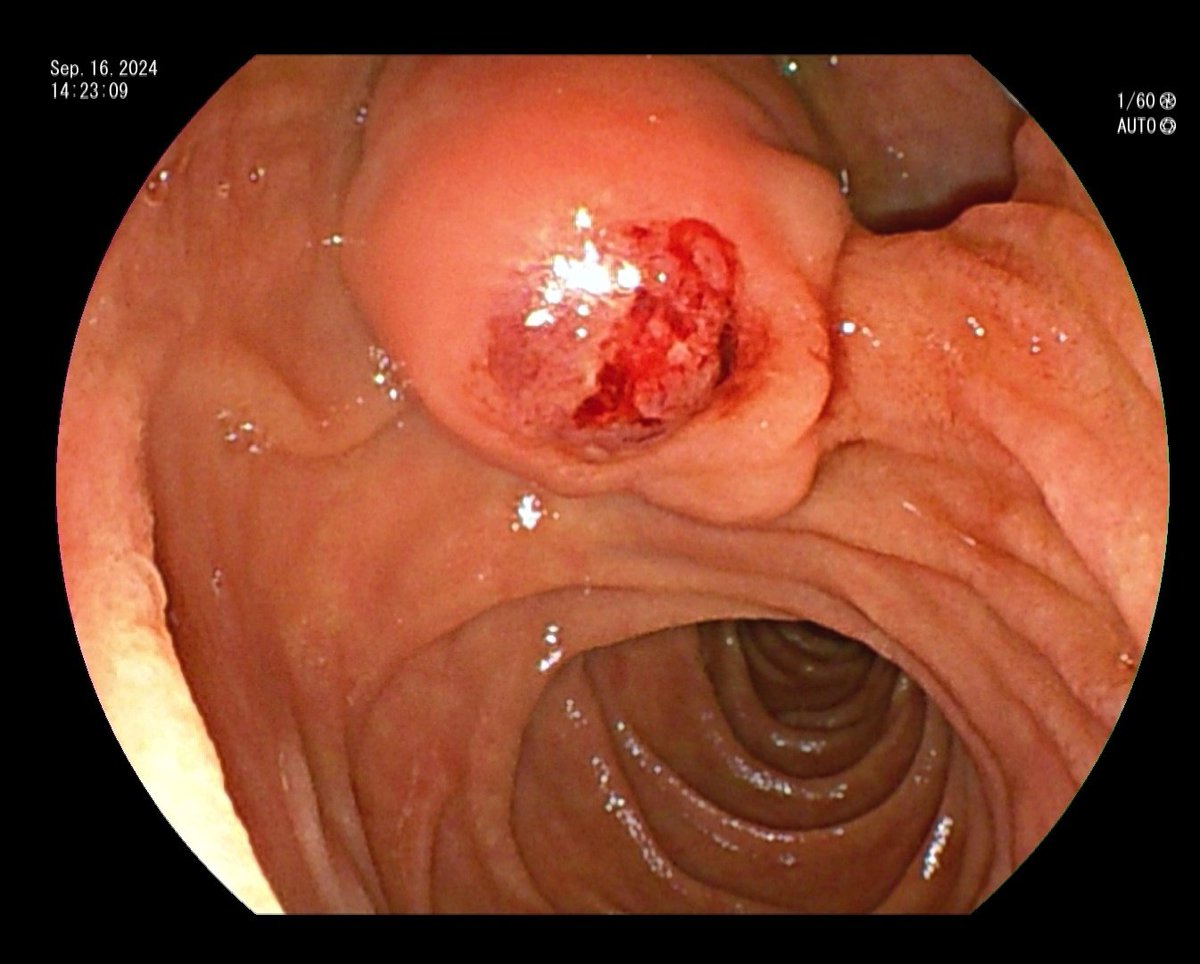 YeseongDavid's tweet photo. Soft tissue density seen on US in distal CBD, ERCP showed this deformity at ampulla. Where would you cannulate? (I got lucky + had excellent coaching) https://t.co/sXyTnFsFt4